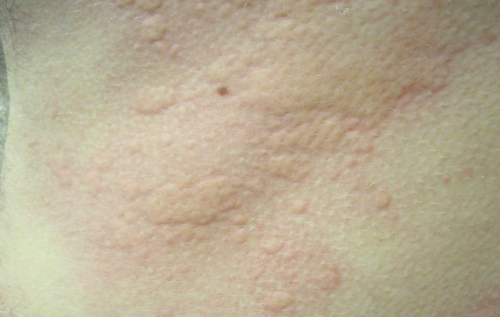 Hives (Urticaria)