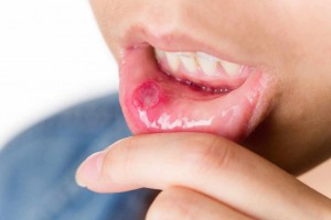 Mouth Ulcer remedies