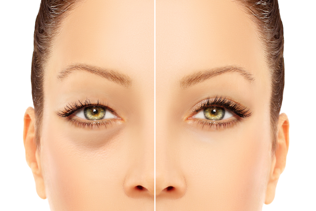 How to Get Rid of Bags Under Eyes