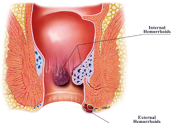 Ginger for anus hemorrhoids