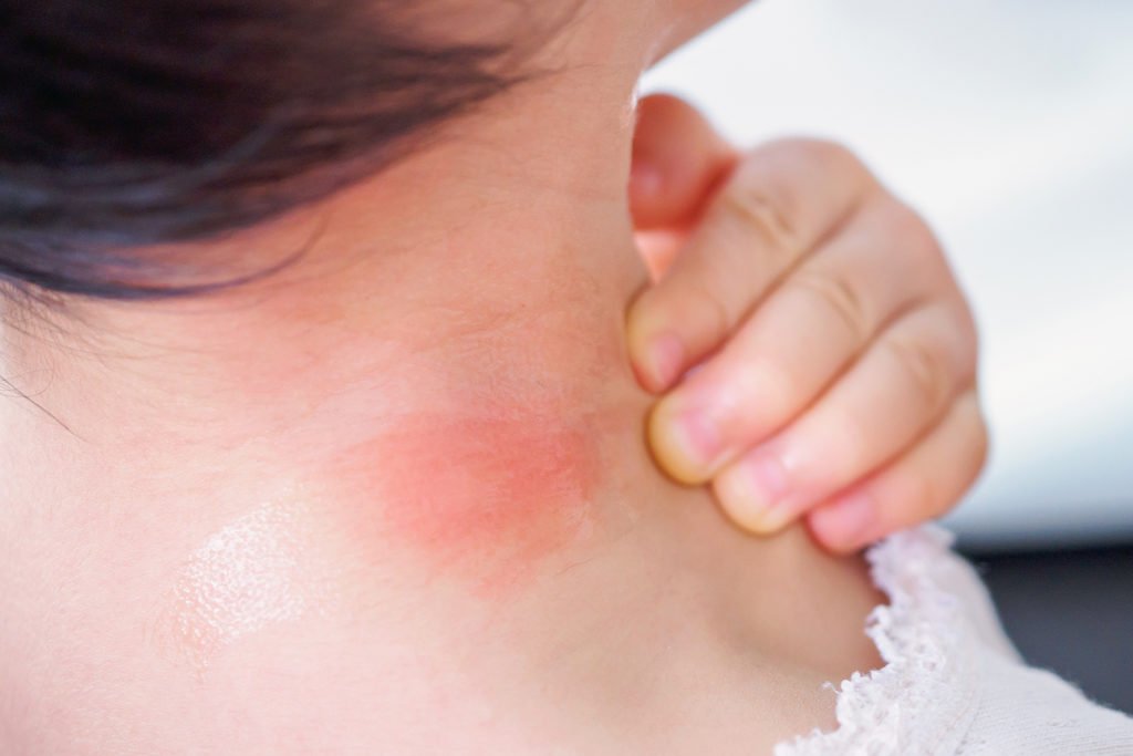 home remedies for bug bites that itch and swell
